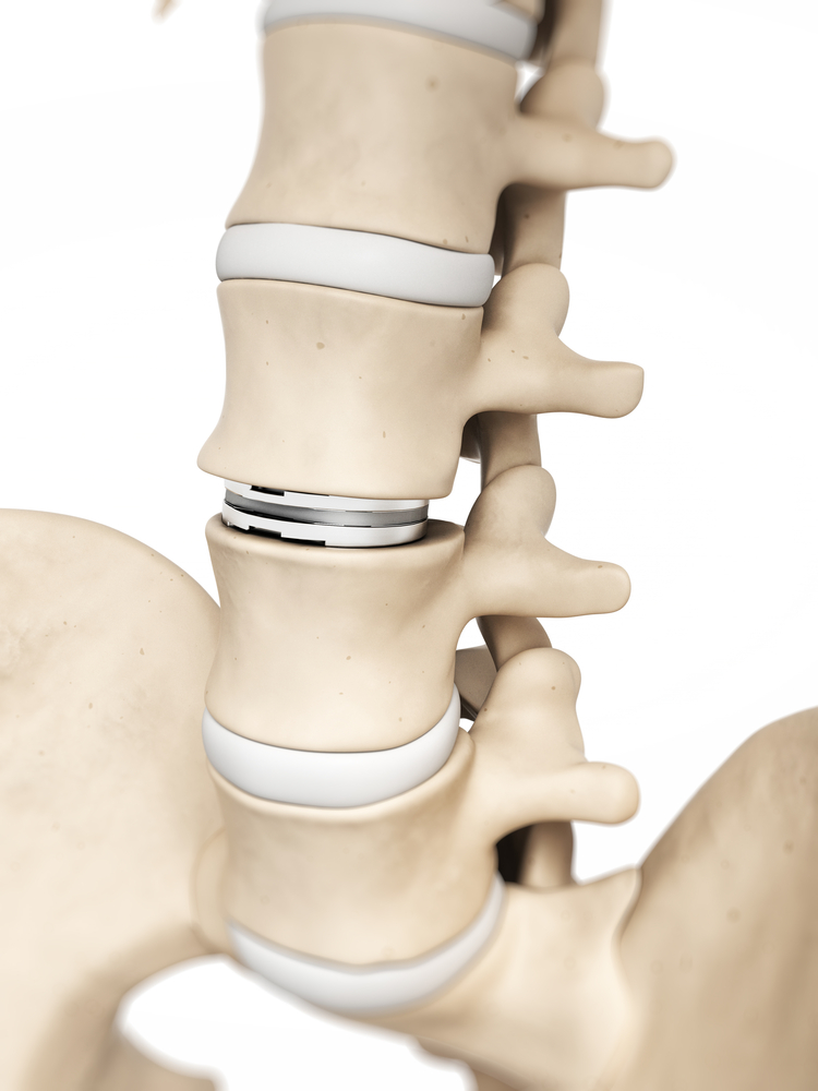 disc-replacement-hamid-mir-m-d-spine-surgeon-orange-county