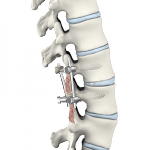 Learn about the types of spinal fusion surgery