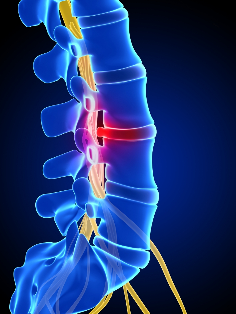 What is a herniated disc