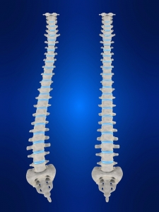 Scoliosis is a curvature of the spine.
