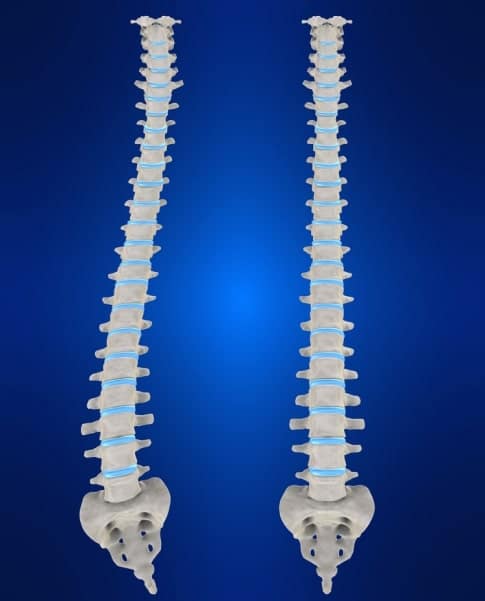 Scoliosis