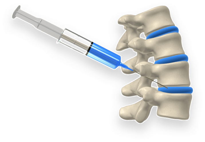 Non Surgical Spine treatment