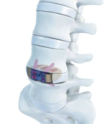 Disc in Spine