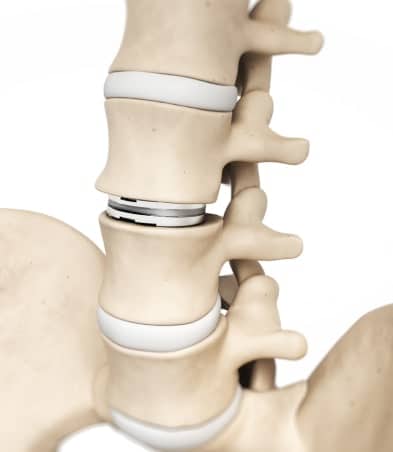 Herniated Disc in Spine