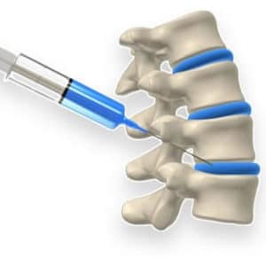 Learn more about the types of spinal injections and how they can help with backneck pain