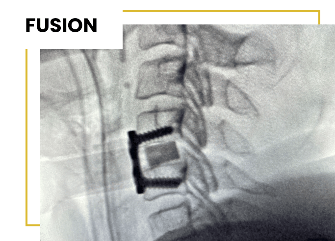 Spinal Fusion