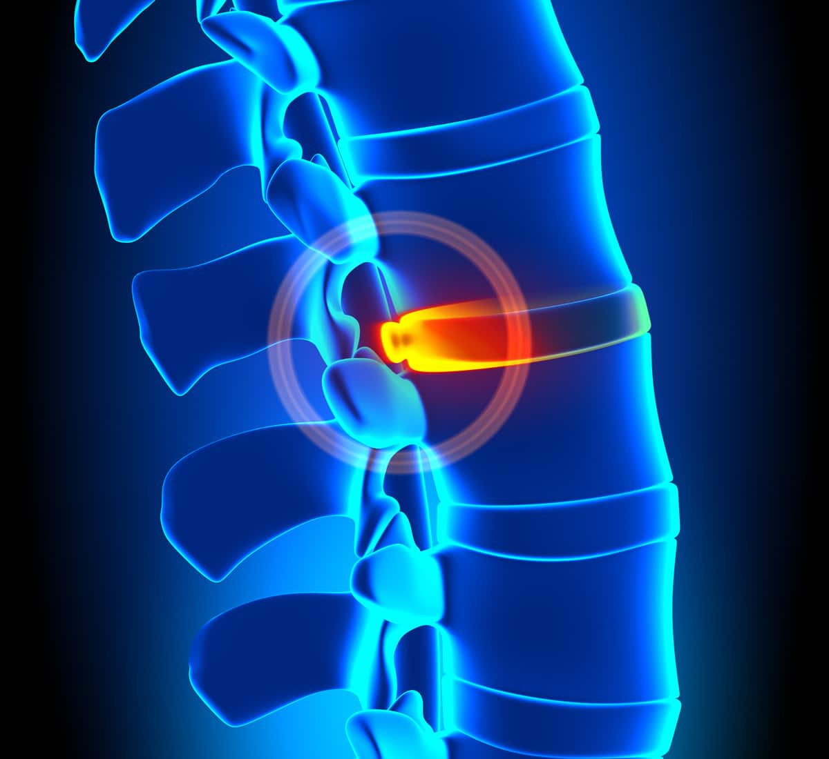Bulging Disc vs. Herniated Disc: What’s the Difference?